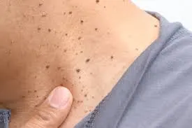 Seborrheic Keratosis: Understanding Skin Changes and CryoPen Treatment Options Bognor-Regis