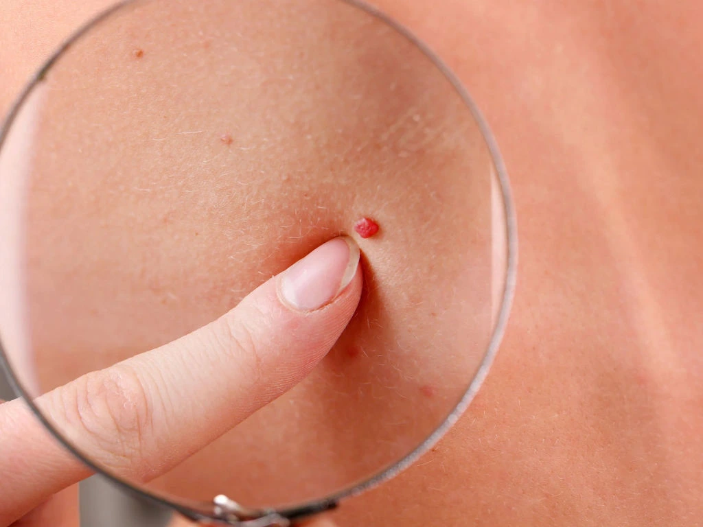 Cherry Angiomas on skin showing vascular structure and Cryosonic CryoPen treatment for effective lesion removal Bognor-Regis