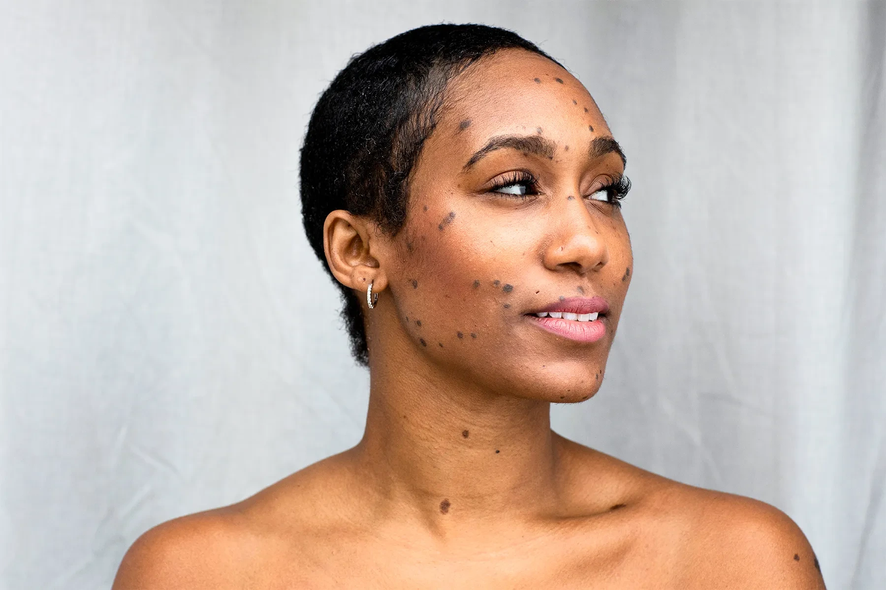 Dermatosis Papulosa Nigra on darker skin treated with Cryosonic CryoPen, showing genetic factors and effective removal Bognor-Regis