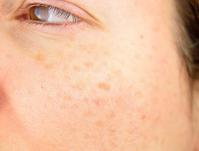 Close-up view of skin showing Solar Lentigines Bognor-Regis, Bognor-Regis