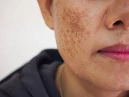 skin showing uneven tone and dark patches caused by Solar Lentigines Bognor-Regis age spots on sun-exposed areas Bognor-Regis